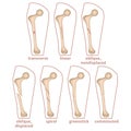 Infographic with types of fractures of the human femur. Royalty Free Stock Photo